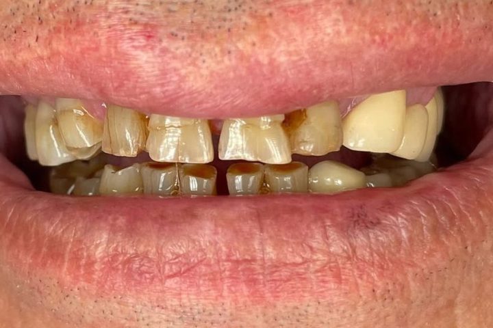 Înainte: Dinți uzați sever, refăcuți cu coroane pe dinți naturali și bonturi personalizate
